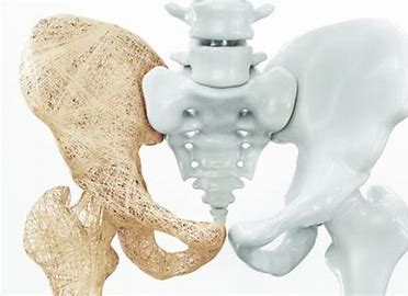 Prévenir l’ostéoporose après 50 ans